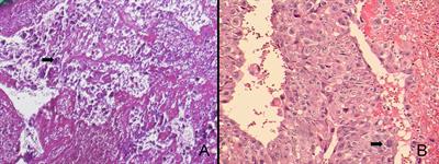 A Successfully Treated Multiple Metastatic Choriocarcinoma Coexistent With Live Fetus: A Case Report and Literature Review